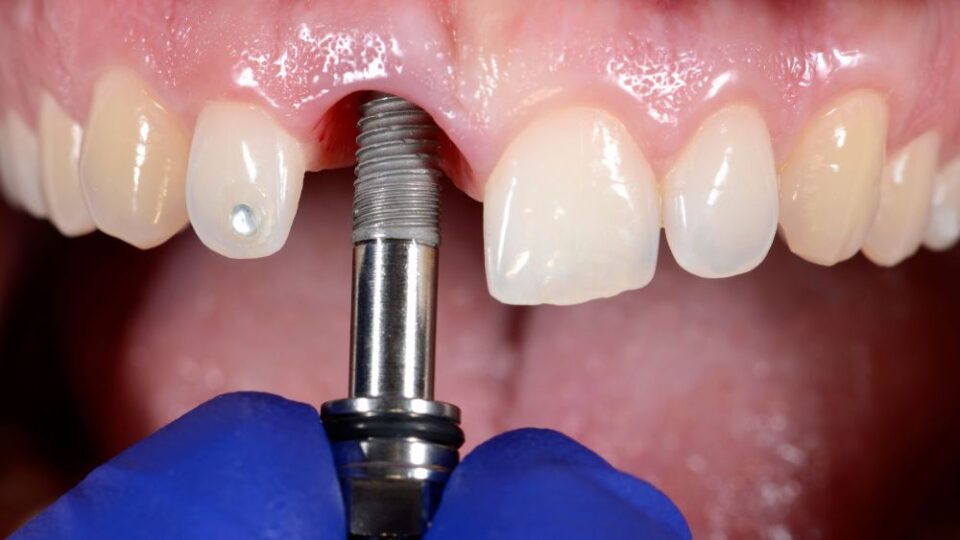 All-on-4 Dental Implants A Comprehensive Guide