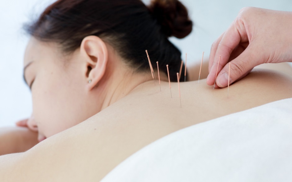 Acupuncture Treatment